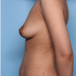 Mommy Makeover Before & After Patient #34324